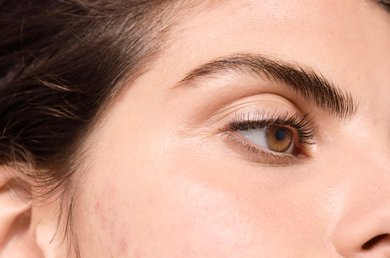 ผลิตภัณฑ์จากนมและการเกิดสิว มีความเกี่ยวข้องกันหรือไม่