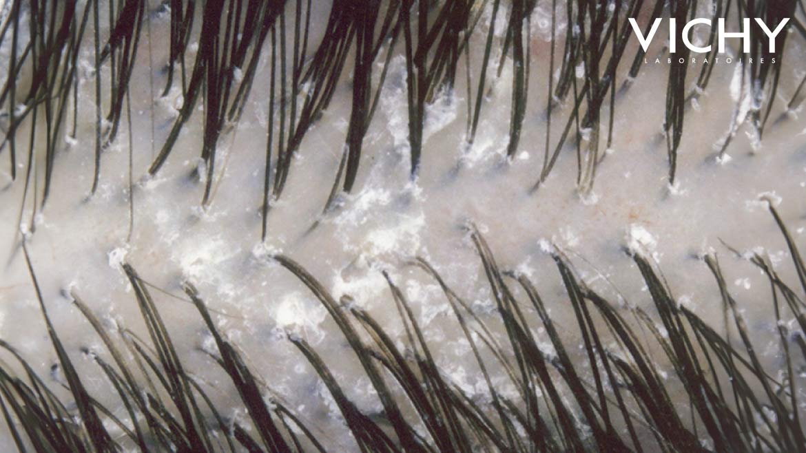 แชมพูขจัดรังแค หนังศีรษะแห้ง