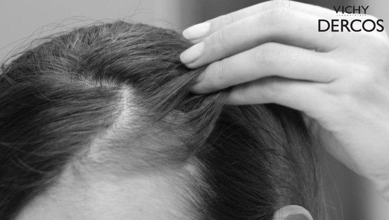 สาเหตุของการเกิดผมร่วง