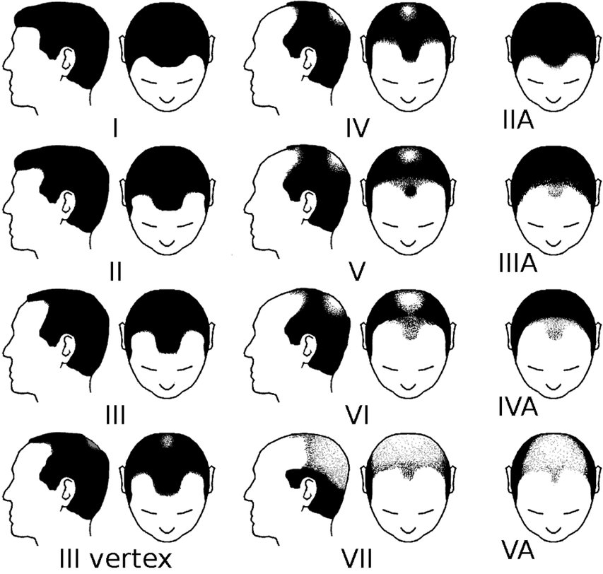 การประเมินผมร่วงผู้ช้าย Hamilton-Norwood scale