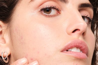 can-food-cause-acne