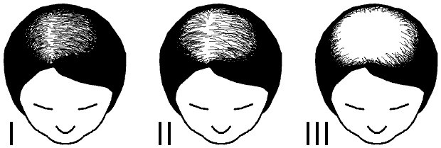 ผมร่วง