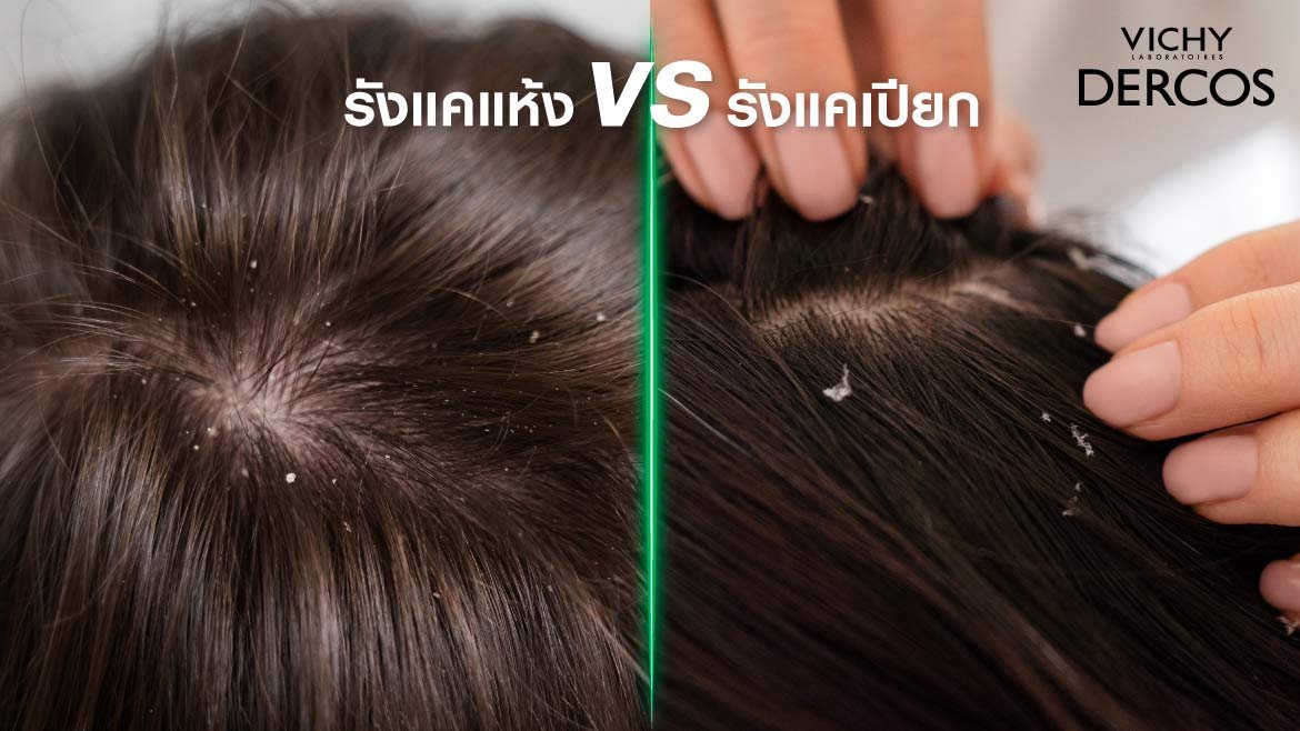 เปรียบเทียบ รังแคเปียก VS รังแคแห้ง